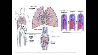 Thrombosis EmbolismViolations microcirculation [upl. by Yager]