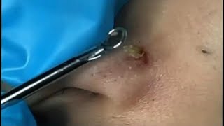 Big Cystic Acne Blackheads Extraction  Blackheads amp Milia  Whiteheads amp Comdones  Pimple Popping [upl. by Crespi]