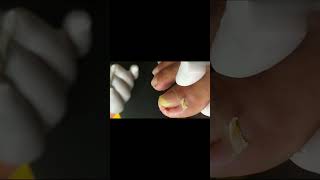 Ingrown toenail removal with Pedicure Knife Cut it easily Ep465 [upl. by Varick171]