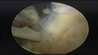 Arthroscopic Suprascapular Nerve Release [upl. by Lonny]