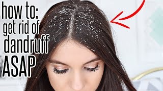 How To Get Rid Of Dandruff After ONE WASH [upl. by Okia992]