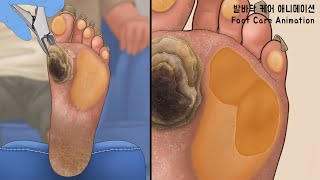 ASMR 딱딱하게 굳고 갈라진 발바닥을 깨끗하게 과각화증 사마귀 굳은살 티눈 제거 애니메이션  Calluses Plantar Warts Corn [upl. by Cohette]