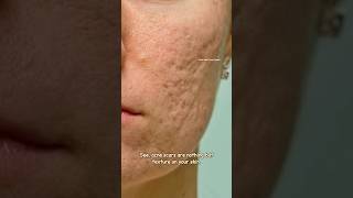 How to get rid of acne scars with Tretinoin  Acne scar Treatment sristydutta acnescars shorts [upl. by Nasya730]