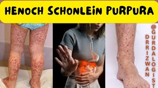 HenochSchonlein Purpura HSP  Symptoms  Cause  Pathology  Biopsy  Treatment  Transplant [upl. by Stauder]