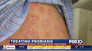 New treatment for psoriasis [upl. by Ennyrb]