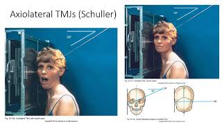 Radiographic Positioning of the TMJs [upl. by Duane]