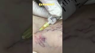 oddly satisfying to watchSpider veins telangiectasias being completely faded [upl. by Eelirrem944]