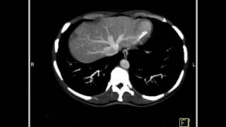 Abdomen Liver Cavernous Hemangioma of the Liver9 of 9 [upl. by Ocer495]