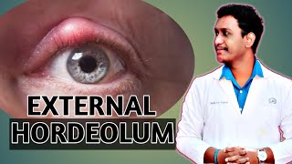 external hordeolum eyelid diseases external hordeolum case presentation 2021 [upl. by Boycey820]