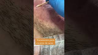 Cicatriz de acne estetica cicatrizes viralshort fyp [upl. by Ardaid]