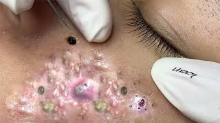 acne blackheads whiteheads removalcystic acne blackhead whitehead removalbig cystic acneextraction [upl. by El444]