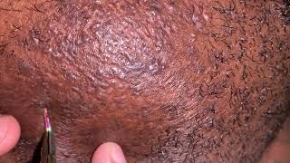 Ingrown Facial Hair Removal Pt1 [upl. by Livesay223]