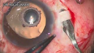 CMT FLEX SCLERAL FIXATION INTRAOCULAR LENS FOR APHAKIA [upl. by Anined522]