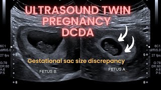 Ultrasound twin pregnancy gestational sac discrepancy Dichorionic diamniotic twin pregnancy [upl. by Adnorahs]