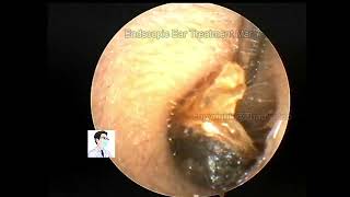 Ear wax removal Common cerumen embolic processing [upl. by Orel]