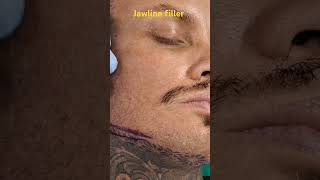 Jawline filler in Mumbai by Dr Vaibhav Shah jawlinefiller [upl. by Granlund]