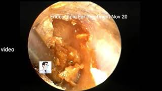 Ear wax removal  Childrens ears [upl. by Ayikur]