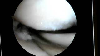 Dr Robert Eppley Arthroscopic Knee Surgery Video  3 [upl. by Lucretia]