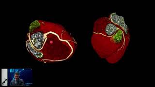 Zastosowanie tomografii komputerowej w obrazowaniu sercowonaczyniowym [upl. by Michiko288]