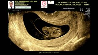 Hygroma Kistik  Hydrops Fetalis  NT Tebal 11 weeks [upl. by Nnairet324]