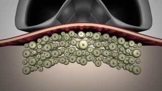 LipoContrast  One step beyond cryolysis [upl. by Laurita]