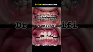 Braces Transformation by Dr MS Saifi brecestransformetion teeth tooth [upl. by Nemlaz704]