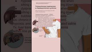 Portopulmonary hypertension vs Hepatopulmonary syndrome [upl. by Timmie64]