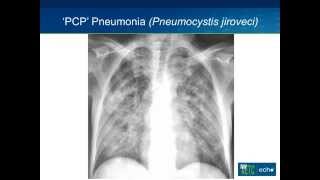 Opportunistic Infections I [upl. by Nirac]