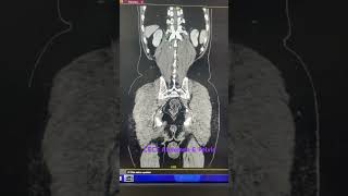 Above CECT findings reveals grade I prostatomegaly with left simple cortical renal cyst as describ [upl. by Craw]