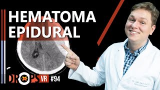 HEMATOMA EPIDURAL – COMO RECONHECER E PORQUE OCORRE [upl. by Ettenwahs387]