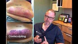 Sculpsure vs Coolsculpting  Which One is Better [upl. by Inasah]