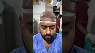 Best Hair Transplant in Delhi just under 25000 hairtransplant hairtransformation hairgrowth [upl. by Elleral]