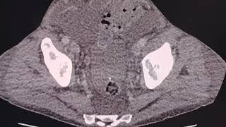 Hemoperitoneum and hemoretroperitoneum in polycystic disease with hemorrhagic renal cysts [upl. by Leis]