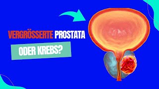 Prostata vergrößert oder Krebs Erkenne die Unterschiede und schütze deine Gesundheit [upl. by Eppilihp584]