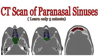 CT scan of paranasal sinuses anatomy [upl. by Bolt]