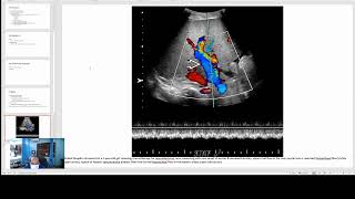 Hepatic Venoocclusive Disease [upl. by Eetsud]