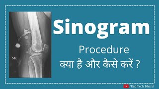 Sinogram Radiological ProcedureSinography [upl. by Gabby]