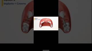 Bridge vs implants vs partial dentures  SIOS has revolutionized the system [upl. by Netsrijk]