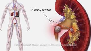 Calcification in Your Body [upl. by Jehoash212]