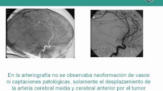 NeurorgsnetTumor cerebral de hemisferio derecho [upl. by Ailehs78]