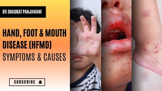 Hand Foot amp Mouth Disease HFMD Symptoms amp Causes [upl. by Hammond]