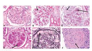 Basics of Renal Pathology  Diabetic Nephropathy [upl. by Lowson]