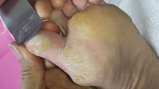 Thick callus on foot Scraped off layer by layer【Joo Yidao】 [upl. by Enyaht342]