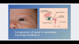 Is my babys eyes infected What is this sticky discharge Dr Sridhar K [upl. by Anauqes]