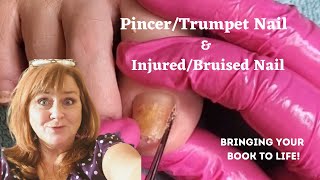 Nail DisorderPincer Nail amp InjuredBruised Nail  336 Nail Disorders transformation [upl. by Allesor]