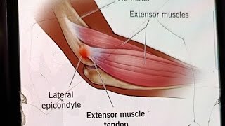 Lateral Epicondylitis Tennis Elbow treatment [upl. by Alemaj]