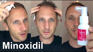 Como Usar Aplicar Minoxidil Tópico para Reverter a Calvicie Hereditaria Queda e Crescer Cabelo Novo [upl. by Almeria]