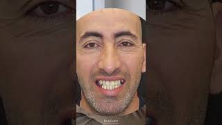 DENTISTE EN TURQUIE  🦷 Témoignage de Faouzi  3 implants dentaires  24 couronnes Emax  BODYEXPERT [upl. by Drake345]