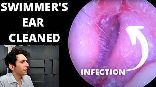 Swimmers Ear Cleaned With Suction Outer Ear Infection [upl. by Sidoney]