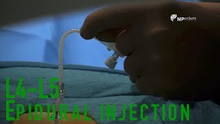 L4L5 epidural injection [upl. by Pennebaker241]